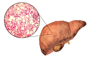 Understanding Fatty Liver